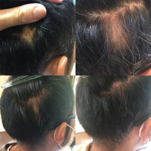 image-円形脱毛へのアプローチ | il divano（イル・ディヴァーノ）